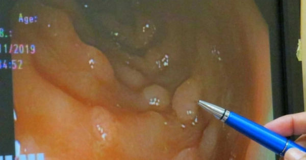 Khám phá các thói quen đơn giản giúp phòng ngừa polyp và ung thư hiệu quả