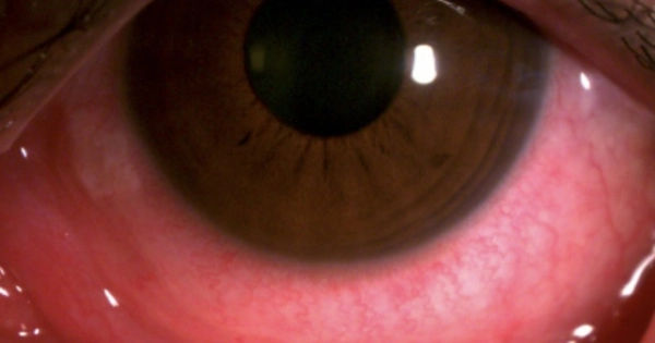 Bí quyết loại bỏ đau mắt đỏ hiệu quả, không lo mất thị lực vĩnh viễn