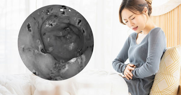 Nguyên nhân sơ xuất khiến dạ dày của phụ nữ bị thủng 30 vết và vấn đề lưu ý về đường tiêu hoá