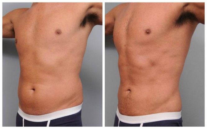 What are the advantages of liposuction?