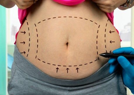 liposuction in ludhiana