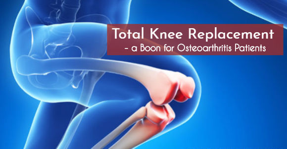 Total Knee Replacement a Boon for Osteoarthritis Patients