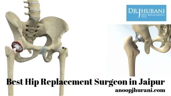 Best Hip Replacement Surgeon in Jaipur