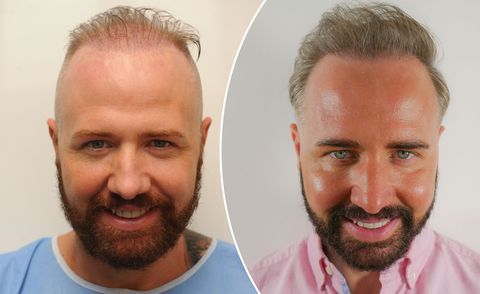 hair transplant in London