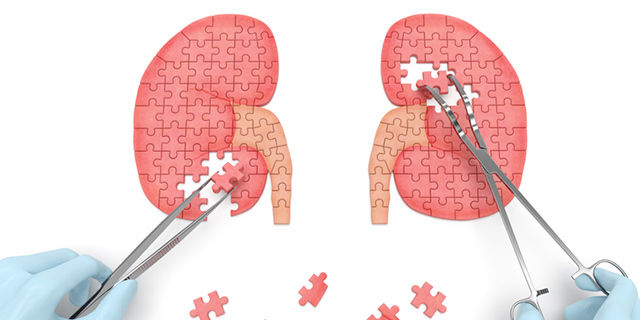 Kidney Transplant in India