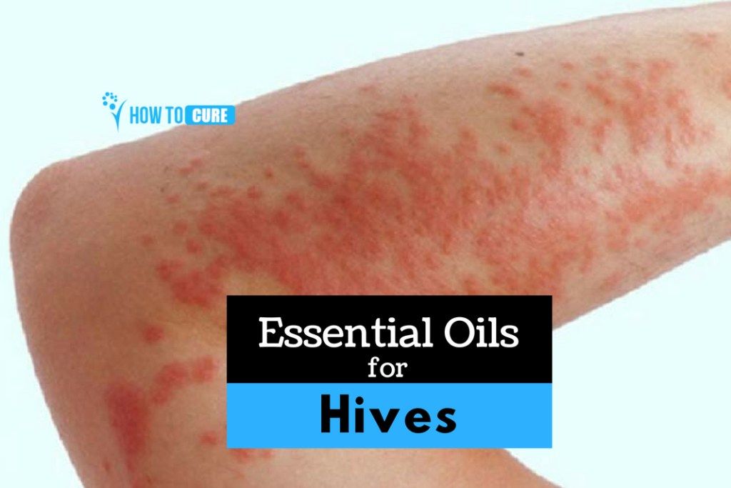https://howtocure.com/essential-oils-for-hives/