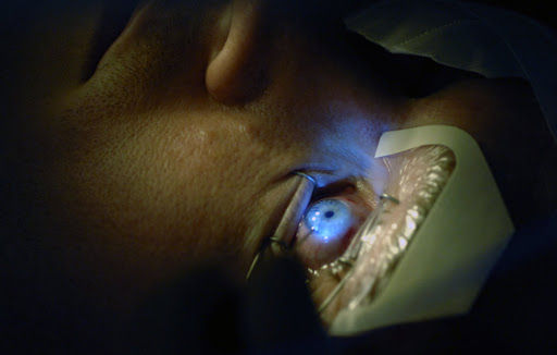 laser eye surgery