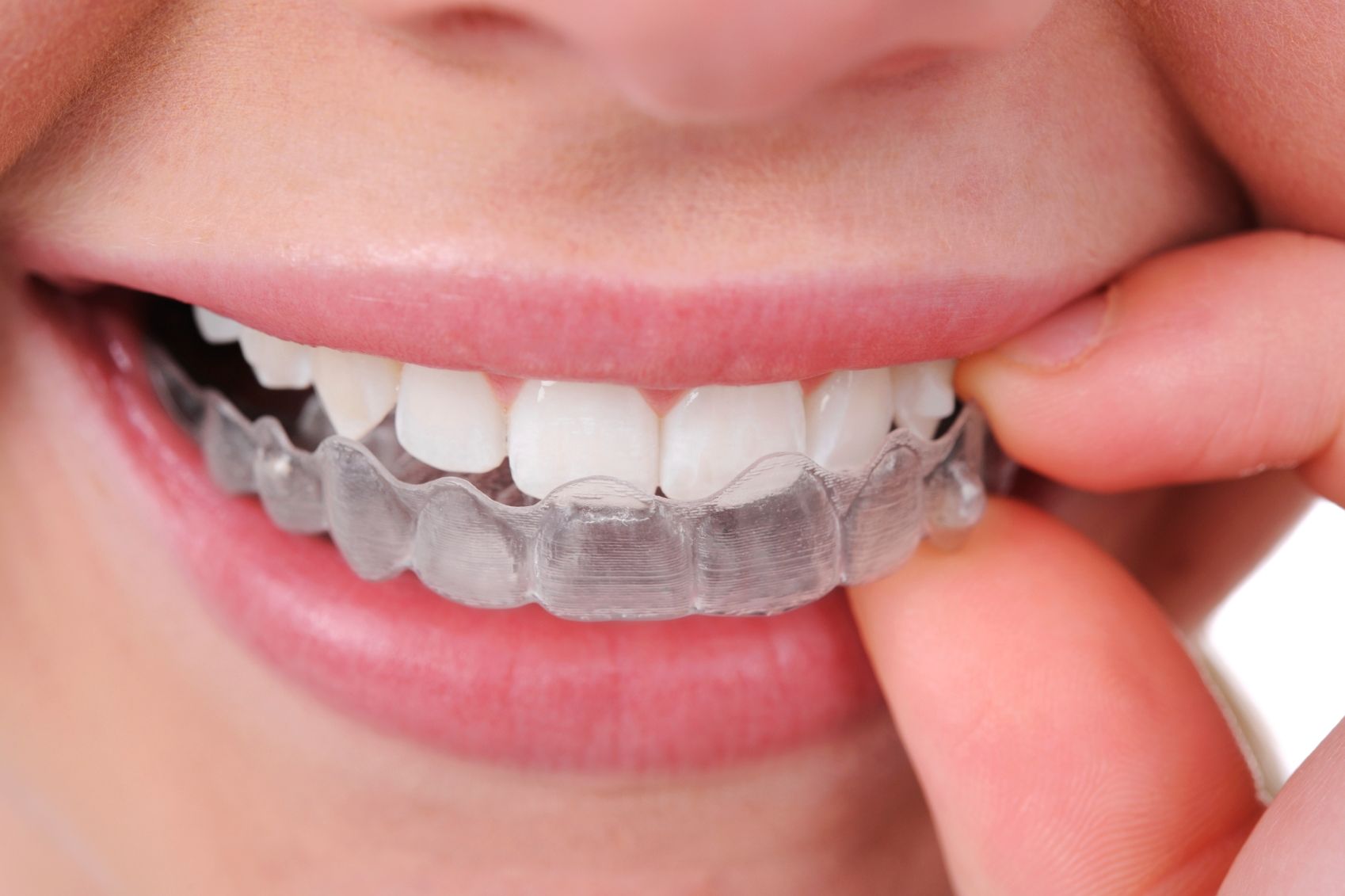 Invisalign Braces