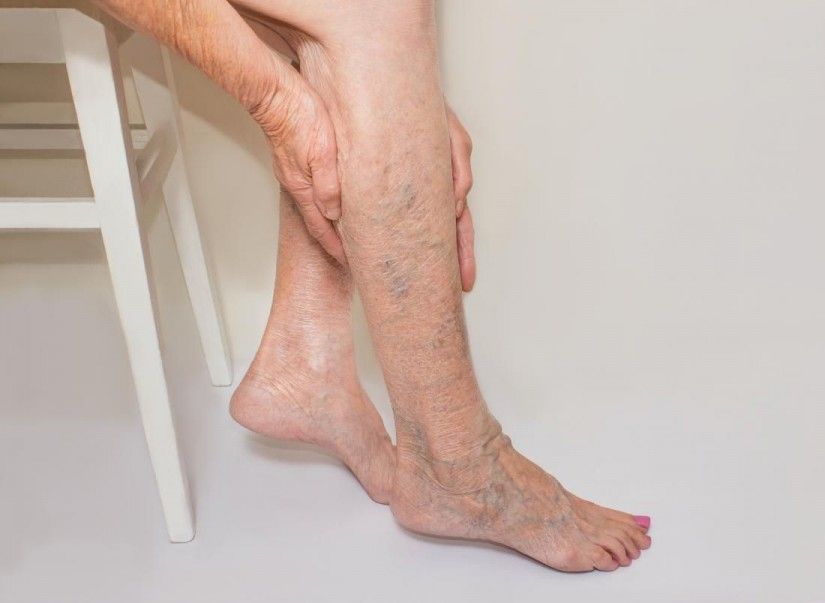 Important Advice On Treating Vein Problem