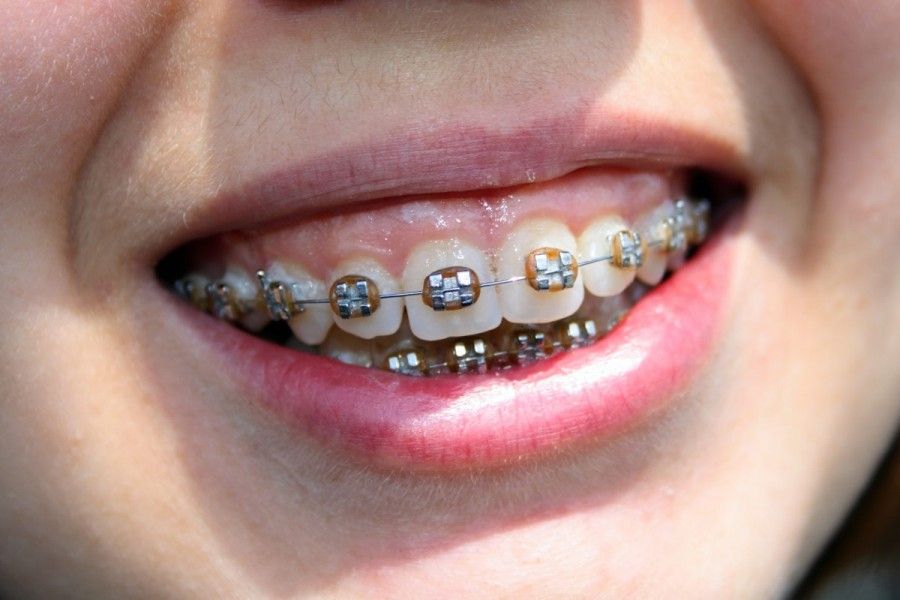 orthodontist invisalign