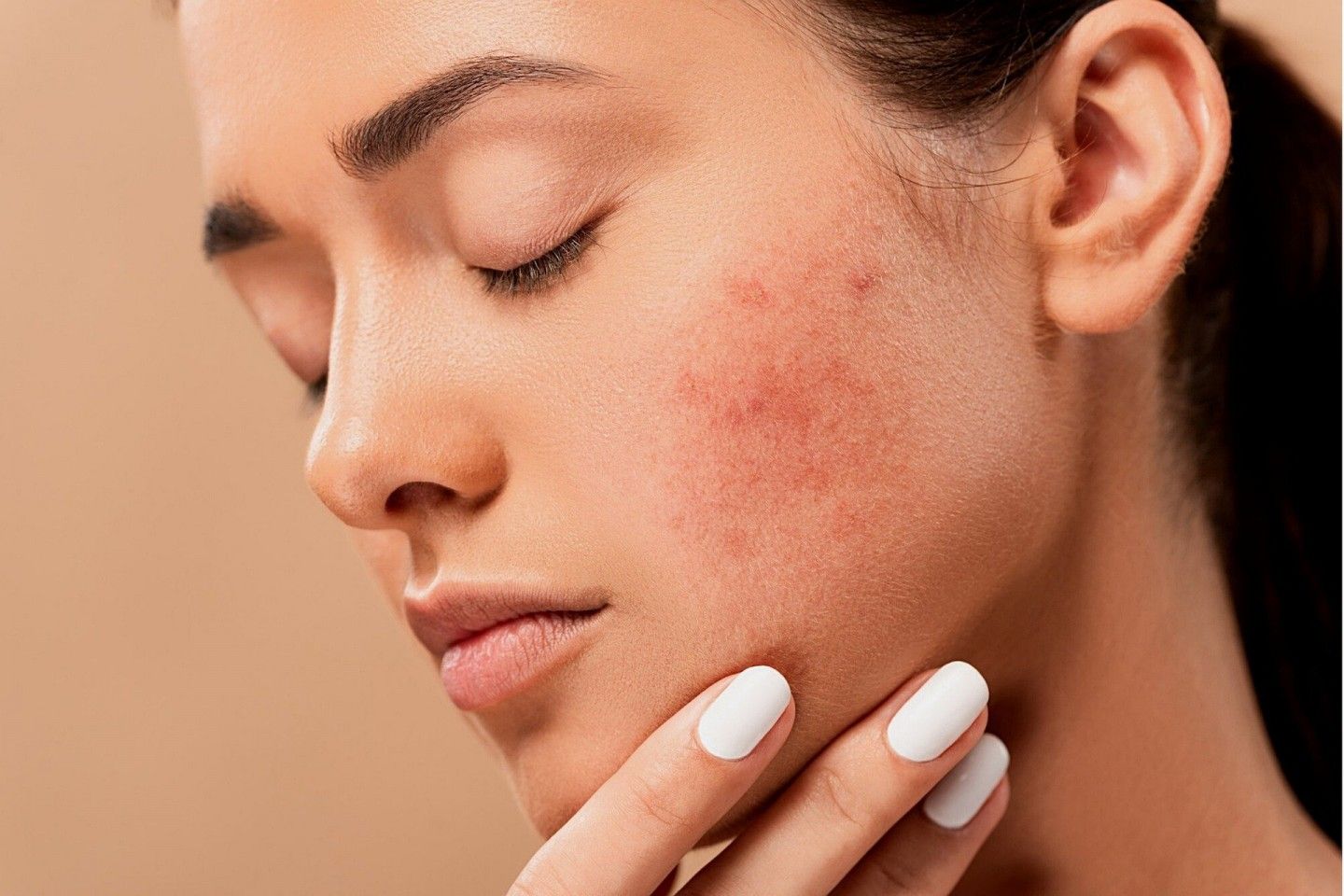 Acne Treatment : Call and Cure