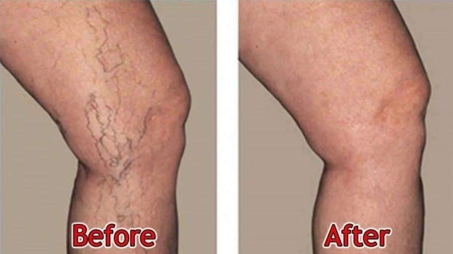 vein treatment near me san Jose