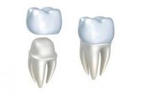 What Makes Dental Implants The Right Choice For Lost Teeth?