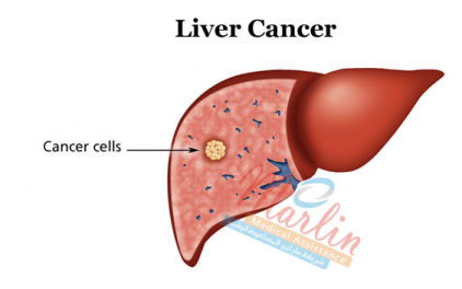 Liver Cancer Treatment India