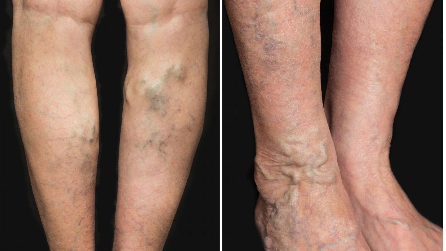 Varicose Veins