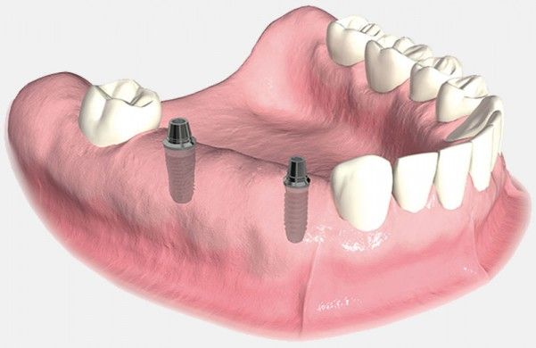 dental implants, dental,