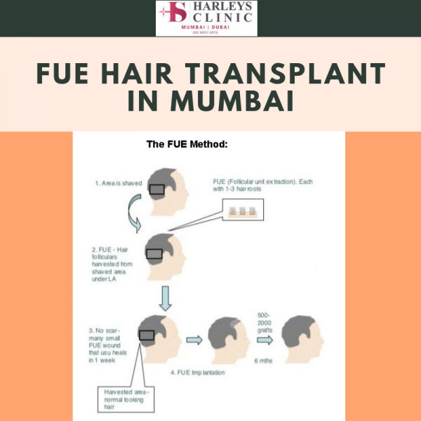 fue hair transplant in mumbai