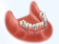 Hybdrid Denture- DentCare Dental Lab