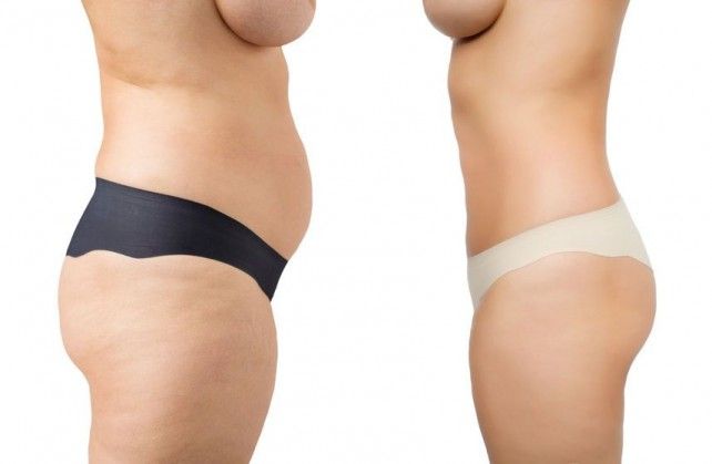 liposuction cost