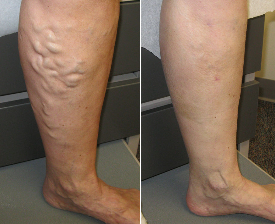 varicose vein treatment near me san Diego