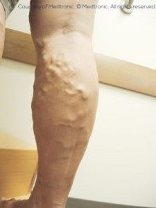 varicose vein doctor near me