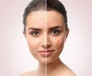 How to Get Rid of a Zit Overnight