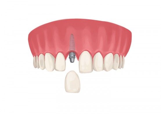 Is there a cheaper alternative to dental implants?