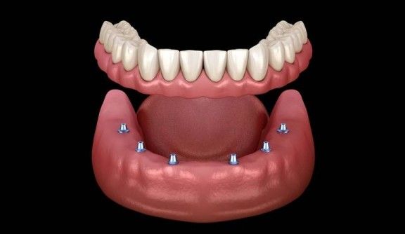 Zirconia Dental Material Market 