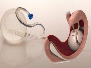 Intragastric Balloons Market to grow at a Significant Rate During the Forecast Period | TechSci Research>