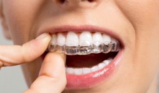 Is overbite getting worse with braces? >