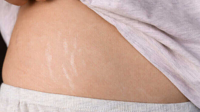 8 Penyebab Stretch Mark di Kulit dan Cara Menghilangkannya