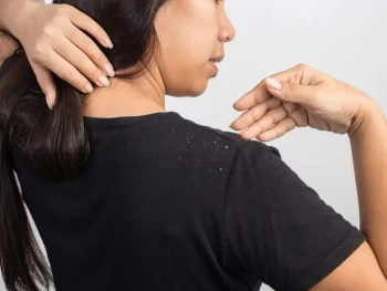 9 Cara Mengatasi Ketombe di Kulit Kepala Secara Alami