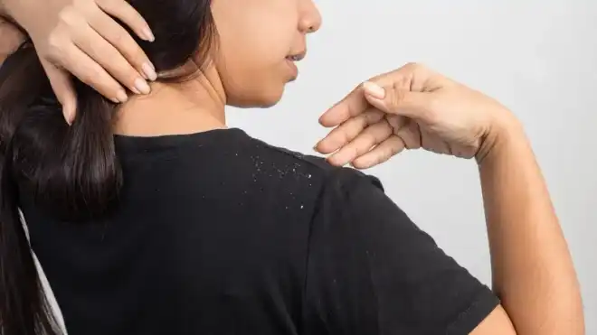 9 Cara Mengatasi Ketombe di Kulit Kepala Secara Alami