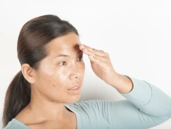10 Cara Mengatasi Minyak Berlebih pada Wajah dengan Efektif