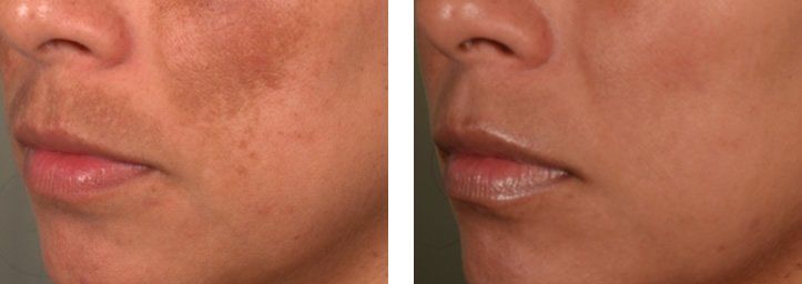 Melasma Pigmentation DubaiWellbeing Medical Centre Lutronic Spectra