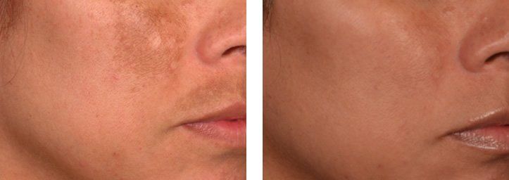 Melasma Pigmentation Dubai Wellbeing Medical Centre Lutronic Spectra