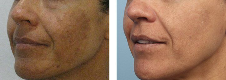 Melasma Pigmentation Dubai Wellbeing Medical Centre Lutronic Spectra