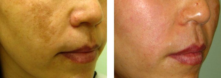 Melasma Pigmentation Dubai Wellbeing Medical Centre Lutronic Spectra