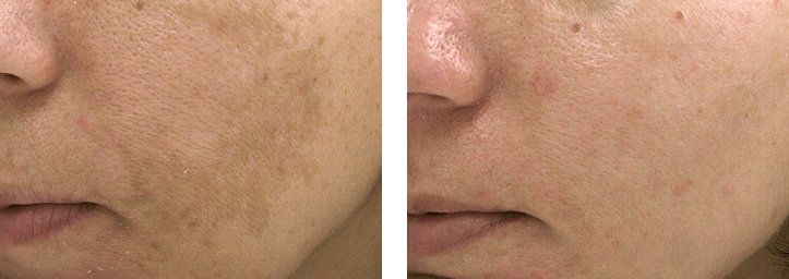 Pigmentation Melasma Chemical Peel Yellow Peel Dubai Wellbeing Clinic