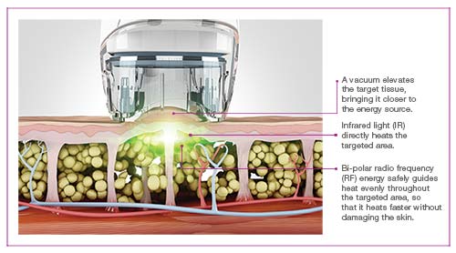 Velashape Cellulite Reduction