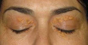 xanthelasma warts removal CO2 laser wellbeing medical centre dubai