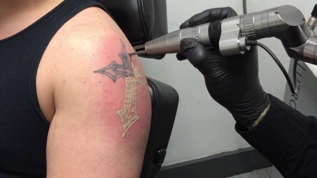 What You Need to Know About Tattoo Removal: SINY Dermatology: Dermatology