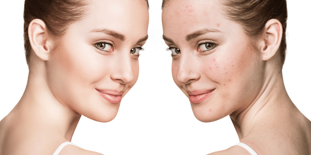 acne scars treatment in dubai