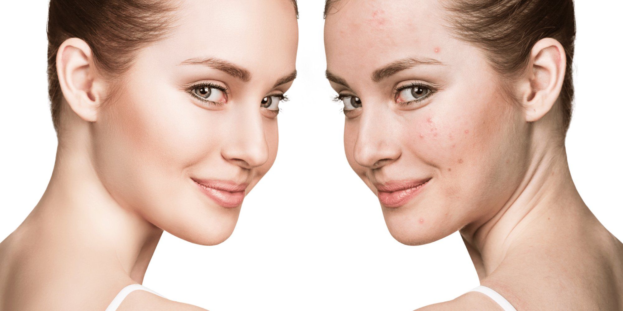 Types of procedures for Acne Treatment in Dubai