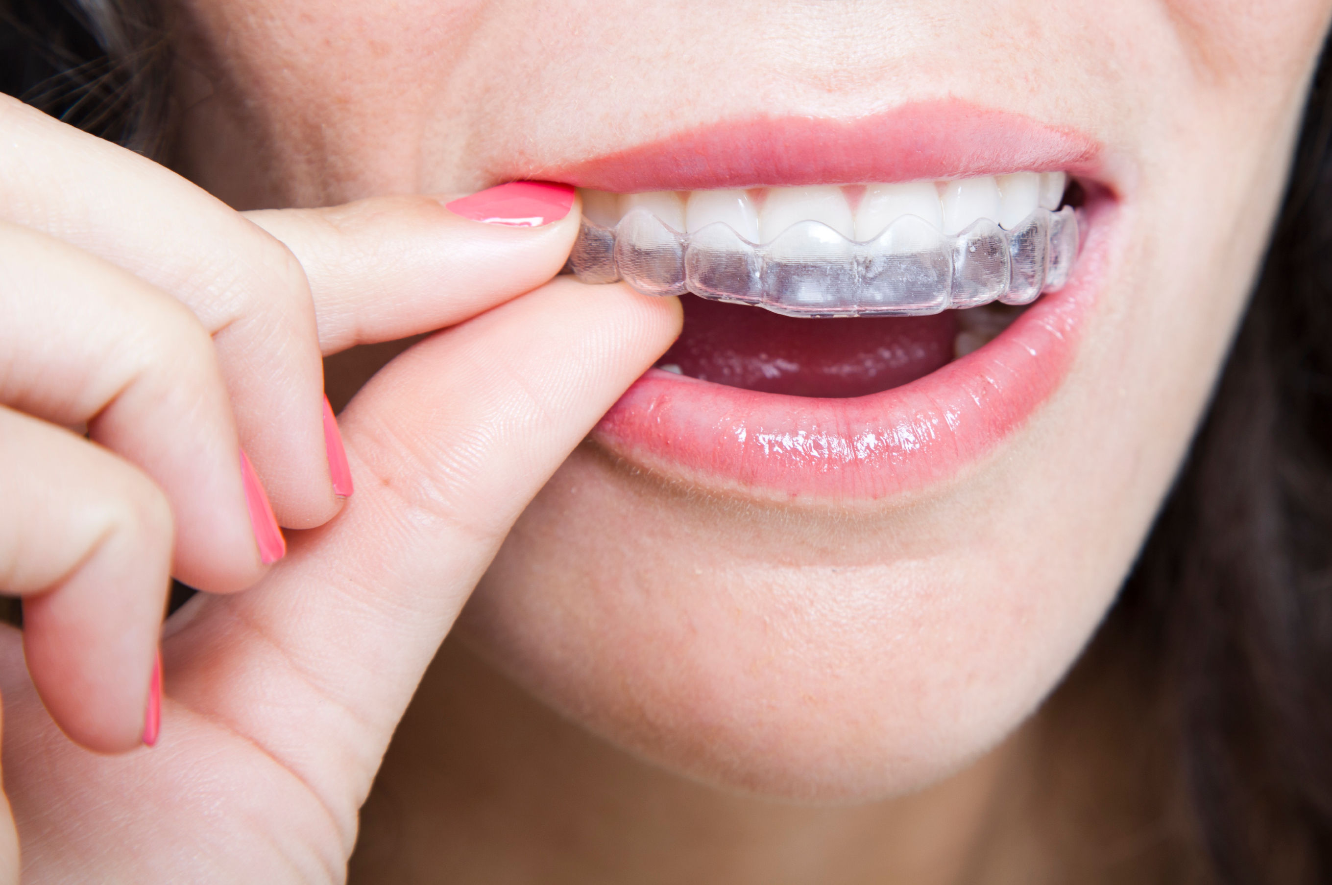 Reasons to switch to invisible aligners from braces