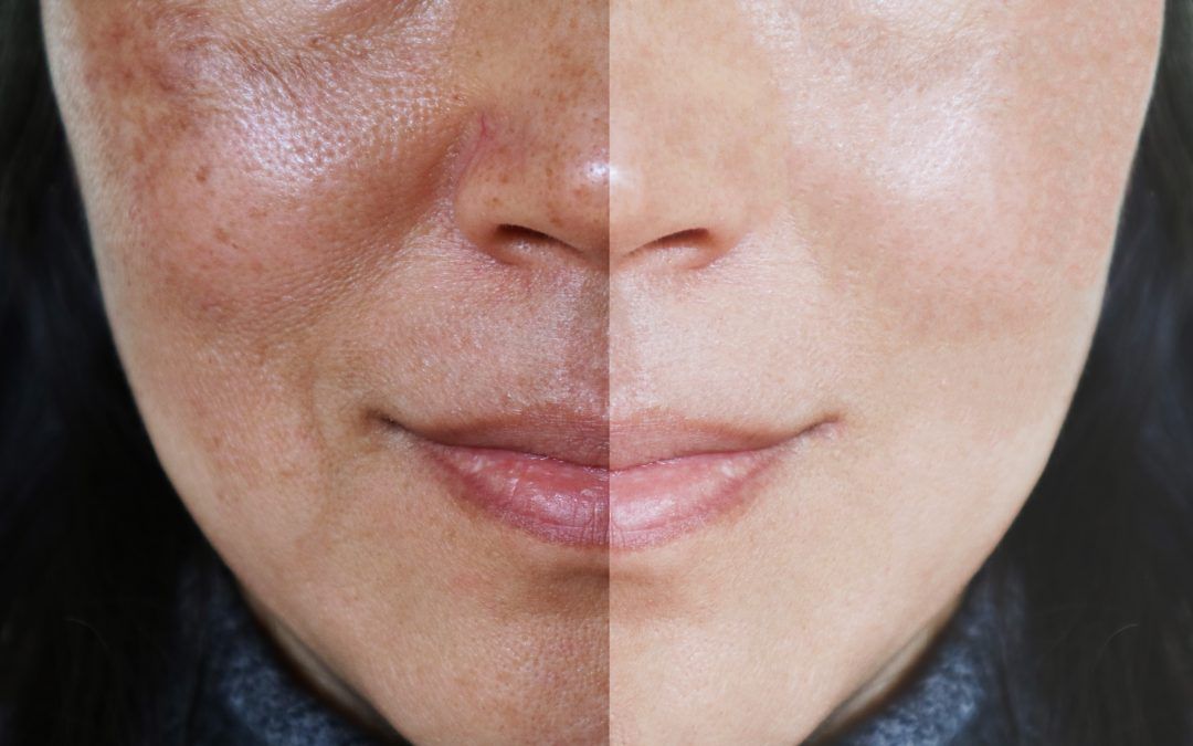 How can one have Melasma treatment in Dubai?