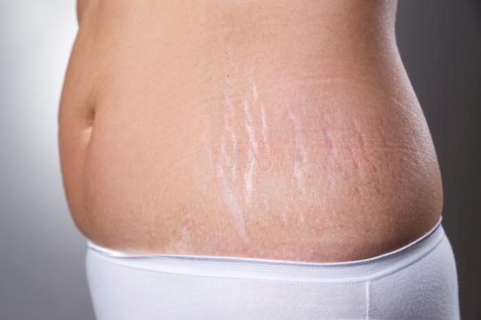 Find the best clinic for stretch marks removal