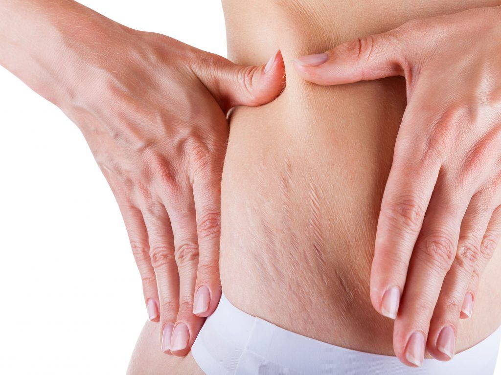 Stretch Mark Removal in Dubai