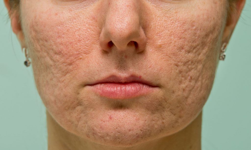 Melasma Treatment in Dubai