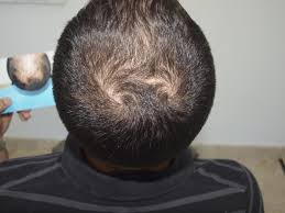 Hair Loss Treatment in Dubai